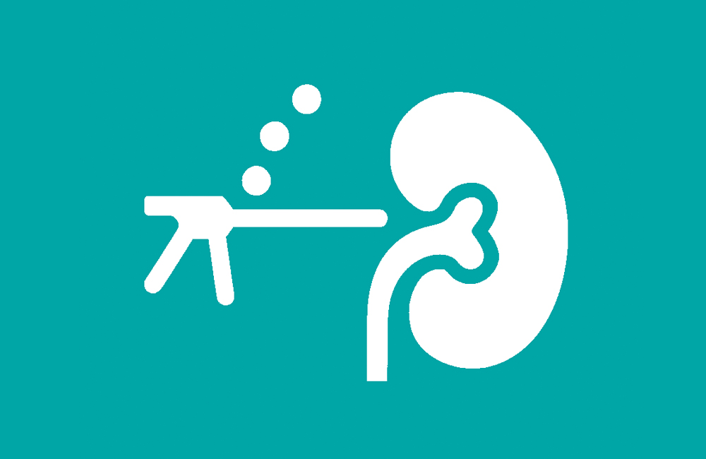 Διαδερμική Νεφρολιθοτριψία (PCNL). Άρθρο του Ουρολόγου Γιατρού Κοριτσιάδη Γεώργιου