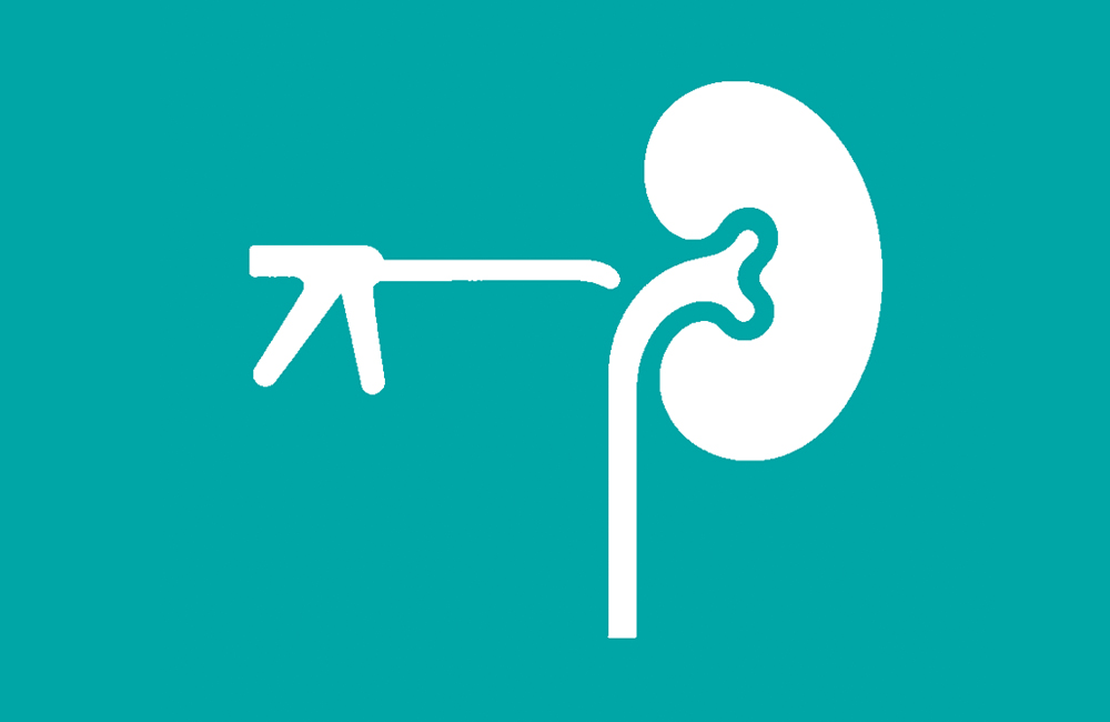 Λιθοτριψία Ουρητήρα. Άρθρο του Ουρολόγου Γιατρού Κοριτσιάδη Γεώργιου